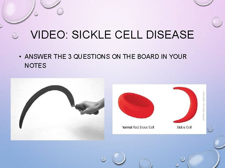 VIDEO: SICKLE CELL DISEASE • ANSWER THE 3 QUESTIONS ON THE BOARD IN YOUR VIDEO: SICKLE CELL DISEASE • ANSWER THE 3 QUESTIONS ON THE BOARD IN YOUR