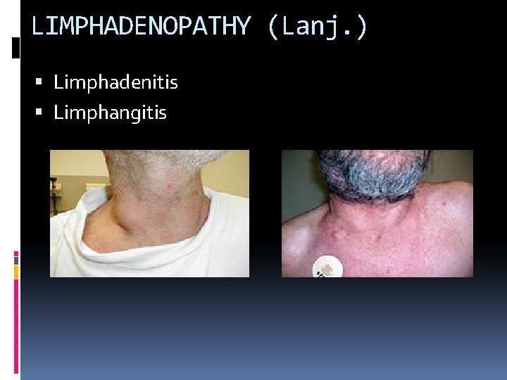 LIMPHADENOPATHY (Lanj. ) Limphadenitis Limphangitis 