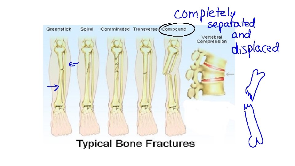 What is a sprain When a joint moves