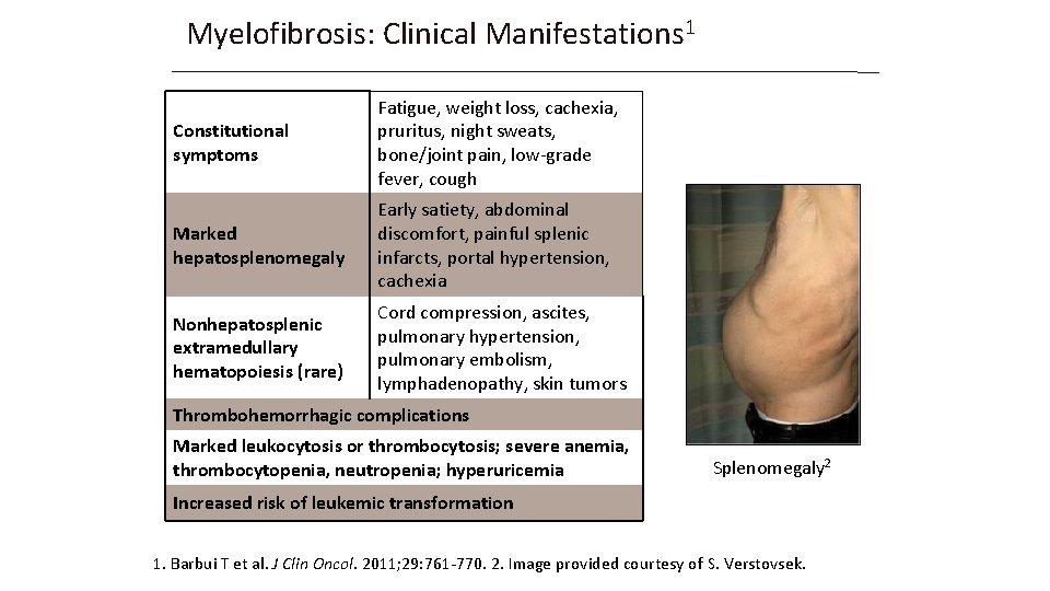 Myelofibrosis: Clinical Manifestations 1 Constitutional symptoms Fatigue, weight loss, cachexia, pruritus, night sweats, bone/joint