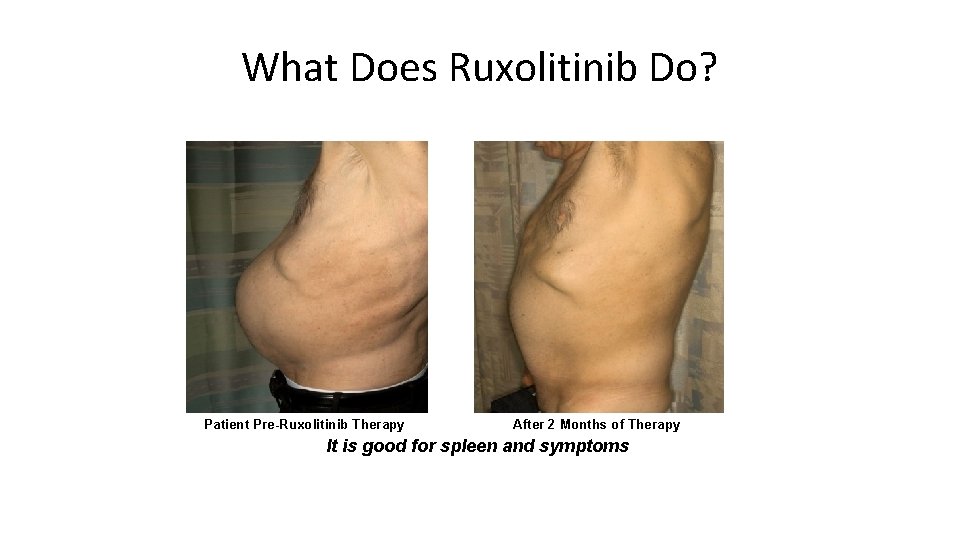 What Does Ruxolitinib Do? Patient Pre-Ruxolitinib Therapy After 2 Months of Therapy It is
