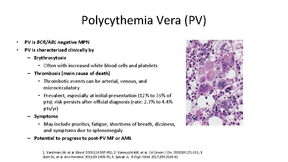 Polycythemia Vera (PV) • • PV is BCR/ABL negative MPN PV is characterized clinically
