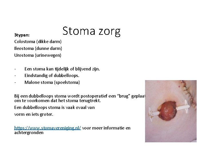 3 typen: Colostoma (dikke darm) Ileostoma (dunne darm) Urostoma (urinewegen) - Stoma zorg Een