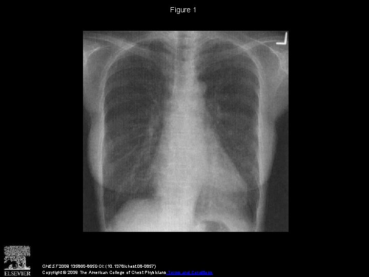 Figure 1 CHEST 2009 135860 -865 DOI: (10. 1378/chest. 08 -0857) Copyright © 2009