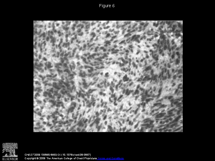 Figure 6 CHEST 2009 135860 -865 DOI: (10. 1378/chest. 08 -0857) Copyright © 2009