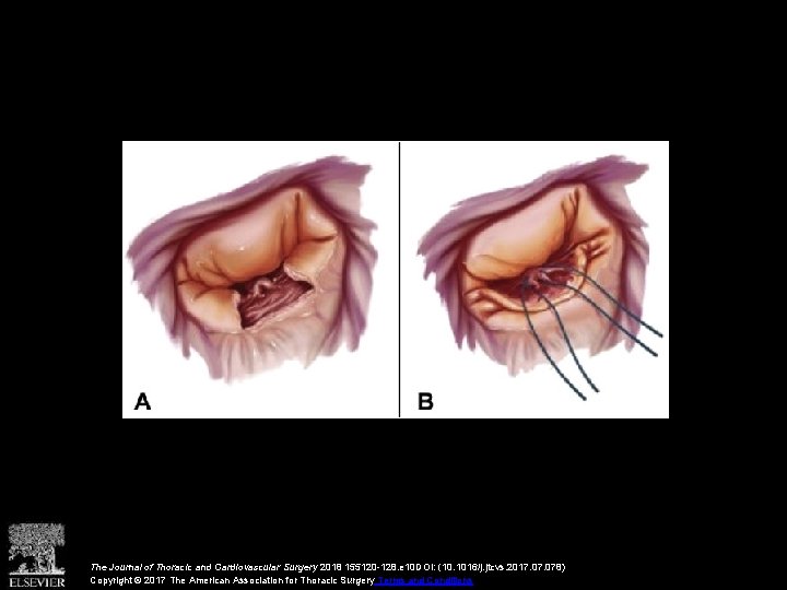 The Journal of Thoracic and Cardiovascular Surgery 2018 155120 -128. e 10 DOI: (10.