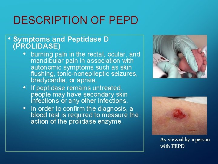 DESCRIPTION OF PEPD • Symptoms and Peptidase D (PROLIDASE) • • • burning pain
