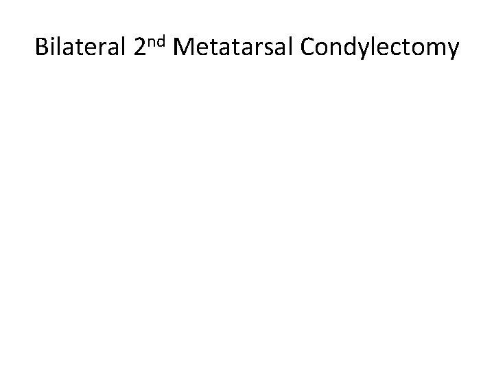 Bilateral 2 nd Metatarsal Condylectomy 