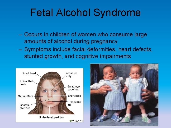 Fetal Alcohol Syndrome – Occurs in children of women who consume large amounts of