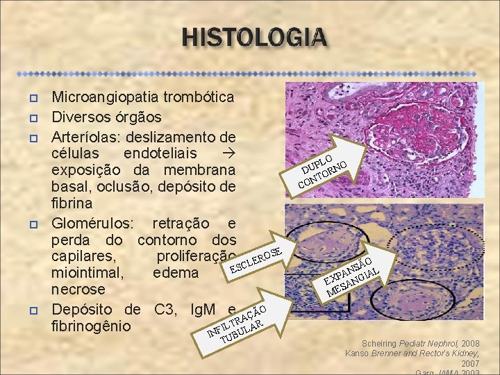  Microangiopatia trombótica Diversos órgãos Arteríolas: deslizamento de células endoteliais exposição da membrana basal,