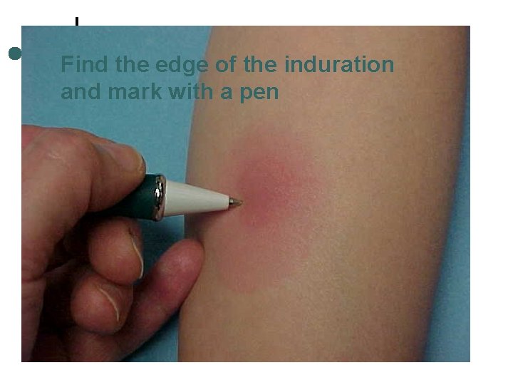 Find the edge of the induration and mark with a pen 