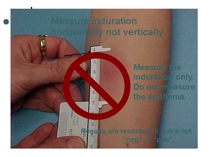 Measure induration horizontally not vertically Measure the induration only. Do not measure the erythema.