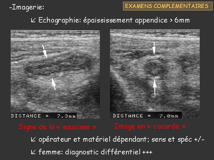 -Imagerie: EXAMENS COMPLEMENTAIRES Echographie: épaississement appendice > 6 mm Signe de la « saucisse