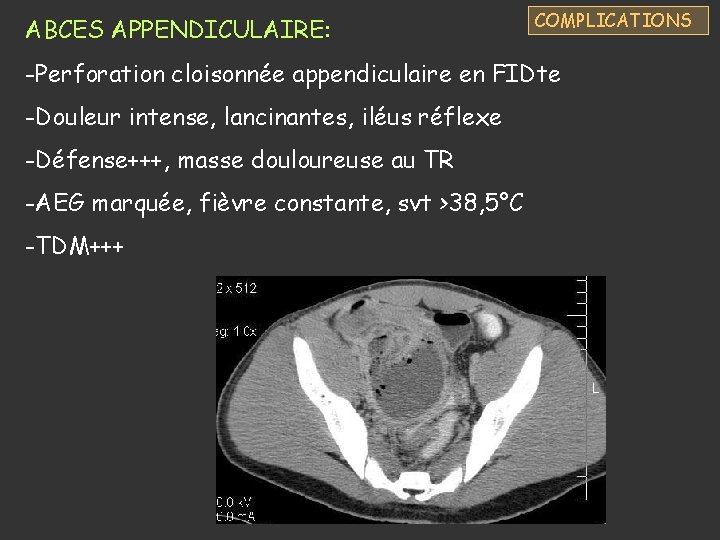 ABCES APPENDICULAIRE: COMPLICATIONS -Perforation cloisonnée appendiculaire en FIDte -Douleur intense, lancinantes, iléus réflexe -Défense+++,