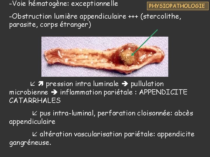 -Voie hématogène: exceptionnelle PHYSIOPATHOLOGIE -Obstruction lumière appendiculaire +++ (stercolithe, parasite, corps étranger) pression intra