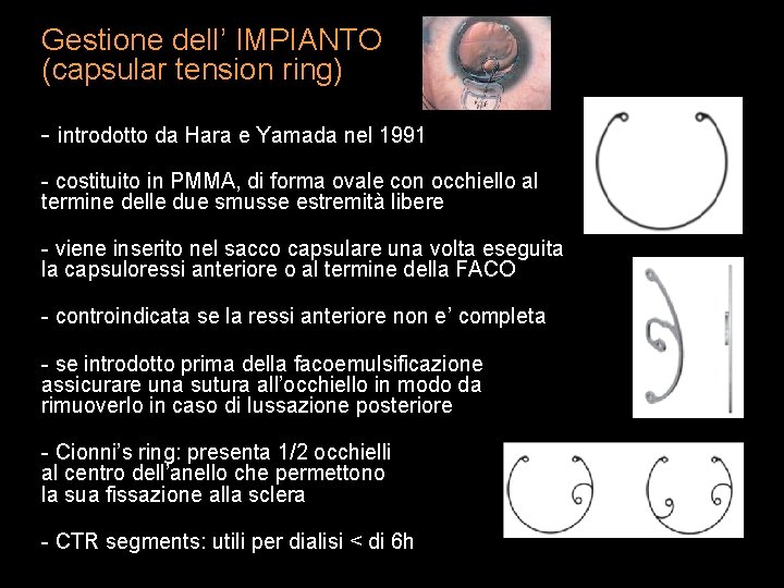 Gestione dell’ IMPIANTO (capsular tension ring) - introdotto da Hara e Yamada nel 1991