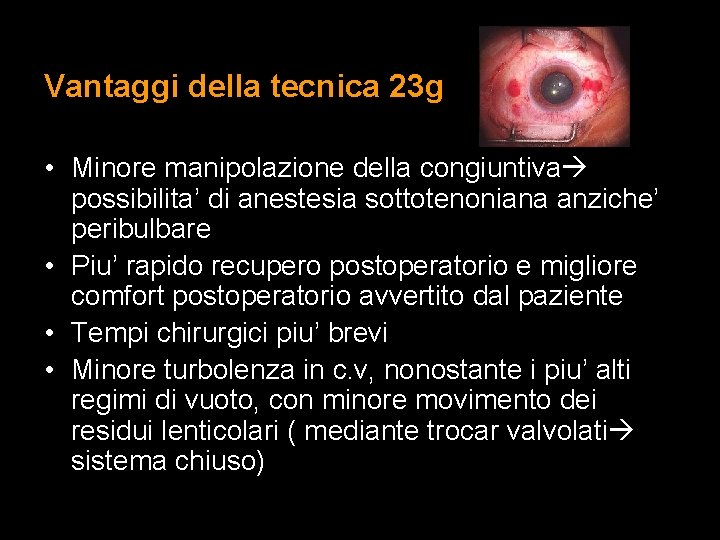 Vantaggi della tecnica 23 g • Minore manipolazione della congiuntiva possibilita’ di anestesia sottotenoniana