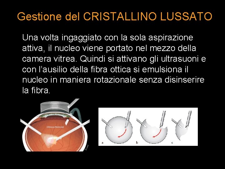 Gestione del CRISTALLINO LUSSATO Una volta ingaggiato con la sola aspirazione attiva, il nucleo