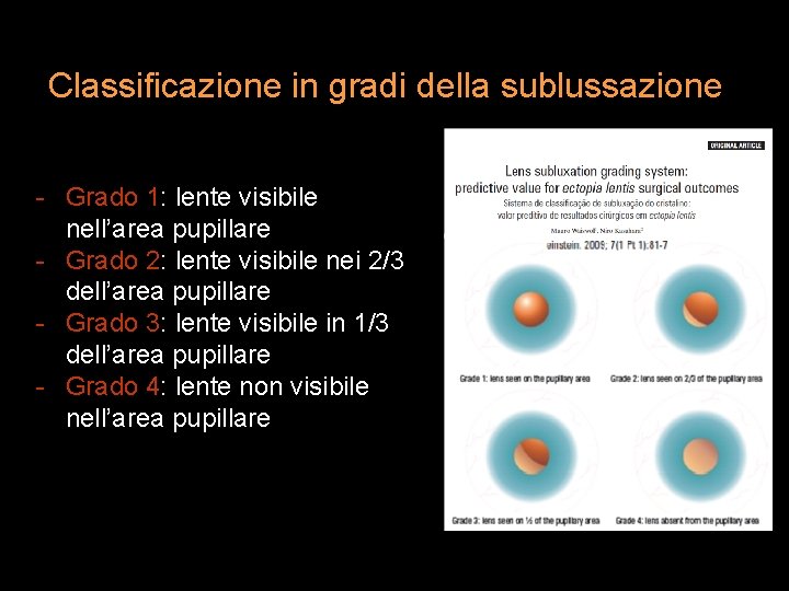 Classificazione in gradi della sublussazione - Grado 1: lente visibile nell’area pupillare - Grado