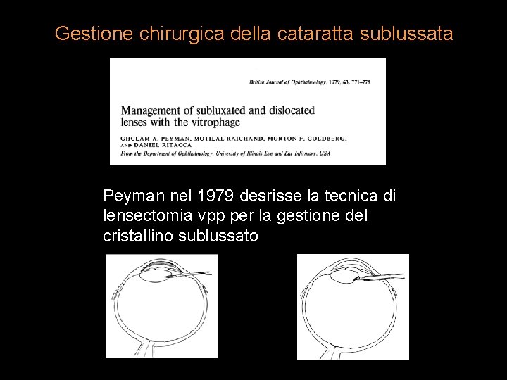 Gestione chirurgica della cataratta sublussata Peyman nel 1979 desrisse la tecnica di lensectomia vpp