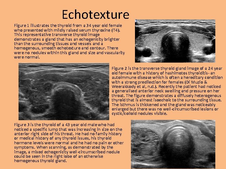 Echotexture Figure 1 illustrates the thyroid from a 34 year old female who presented