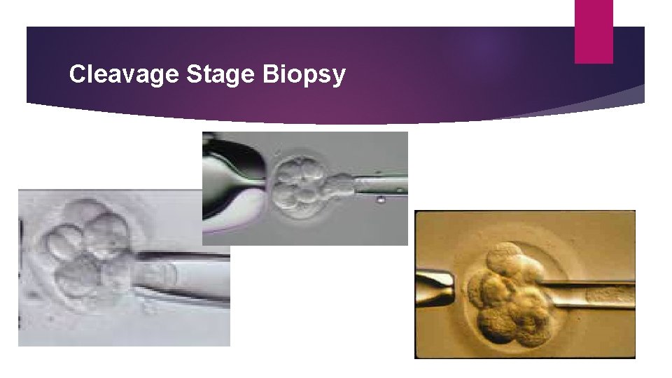 Cleavage Stage Biopsy 