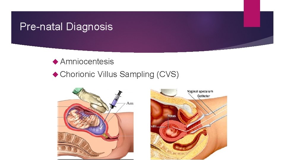 Pre-natal Diagnosis Amniocentesis Chorionic Villus Sampling (CVS) 