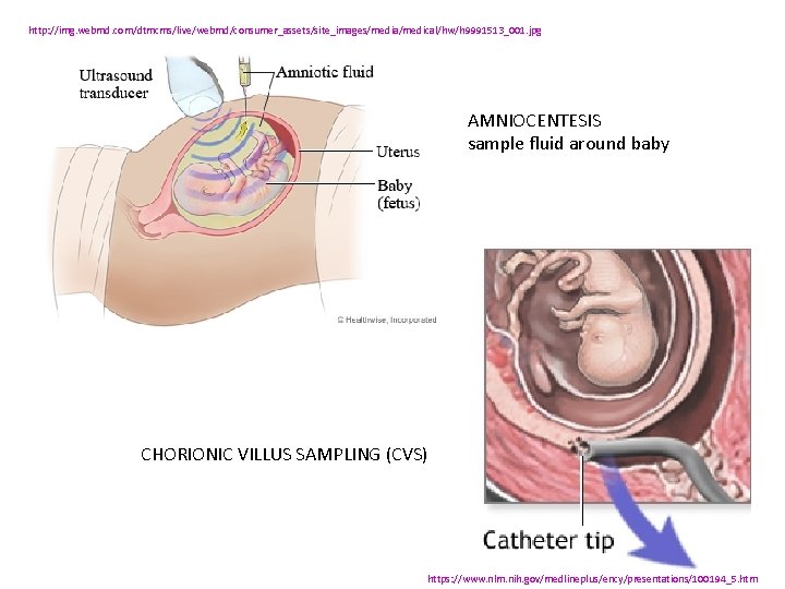http: //img. webmd. com/dtmcms/live/webmd/consumer_assets/site_images/media/medical/hw/h 9991513_001. jpg AMNIOCENTESIS sample fluid around baby CHORIONIC VILLUS SAMPLING