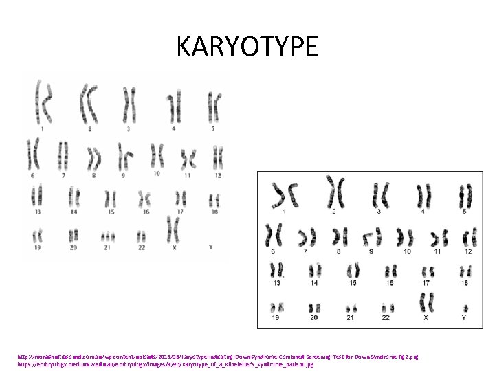 KARYOTYPE http: //monashultrasound. com. au/wp-content/uploads/2013/06/Karyotype-indicating-Down-syndrome-Combined-Screening-Test-for-Down-Syndrome-fig 2. png https: //embryology. med. unsw. edu. au/embryology/images/9/93/Karyotype_of_a_Klinefelter's_syndrome_patient. jpg