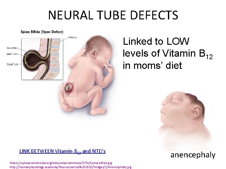 NEURAL TUBE DEFECTS Linked to LOW levels of Vitamin B 12 in moms’ diet