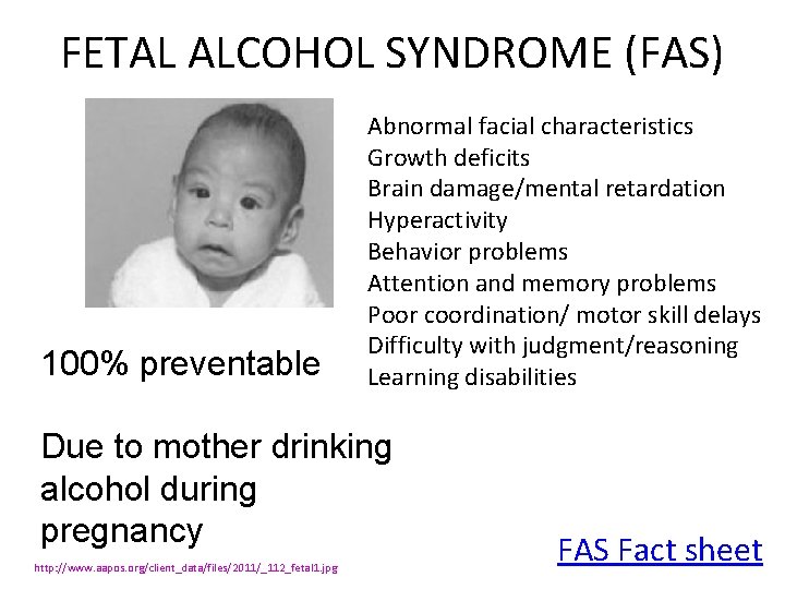 FETAL ALCOHOL SYNDROME (FAS) 100% preventable Abnormal facial characteristics Growth deficits Brain damage/mental retardation