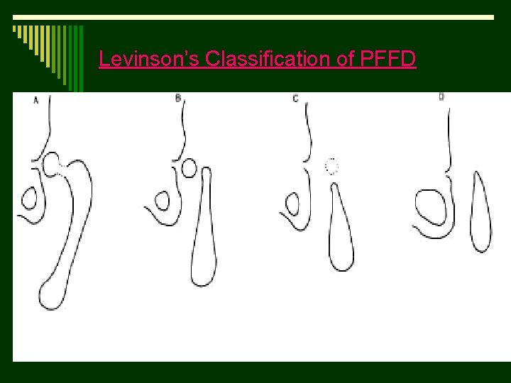 Levinson’s Classification of PFFD 