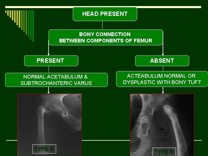 HEAD PRESENT BONY CONNECTION BETWEEN COMPONENTS OF FEMUR PRESENT NORMAL ACETABULUM & SUBTROCHANTERIC VARUS