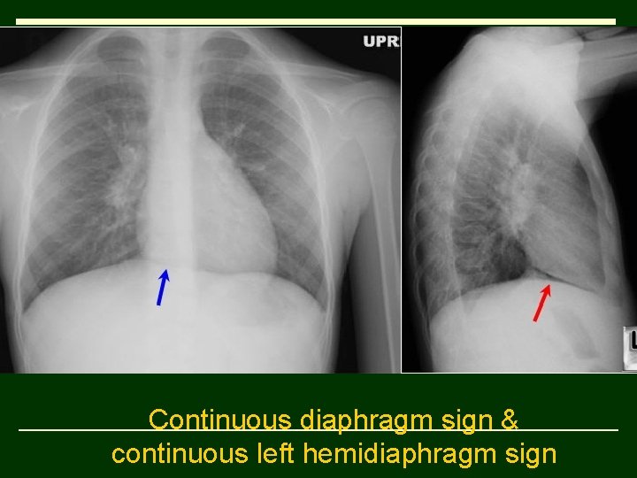 Continuous diaphragm sign & continuous left hemidiaphragm sign 