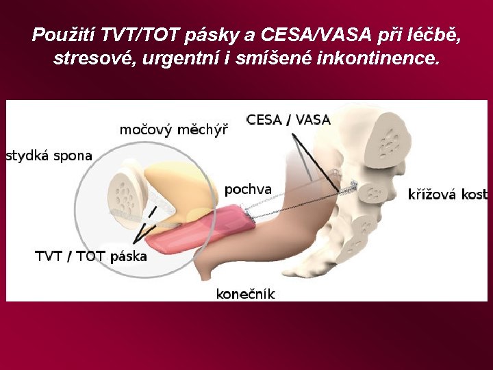 Použití TVT/TOT pásky a CESA/VASA při léčbě, stresové, urgentní i smíšené inkontinence. 