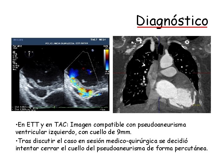 Diagnóstico • En ETT y en TAC: Imagen compatible con pseudoaneurisma ventricular izquierdo, con