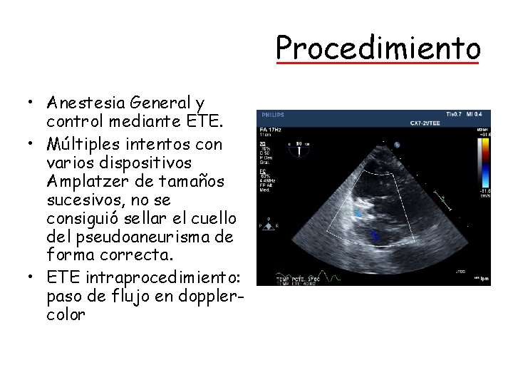 Procedimiento • Anestesia General y control mediante ETE. • Múltiples intentos con varios dispositivos