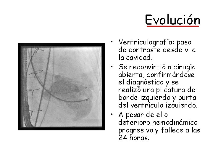 Evolución • Ventriculografía: paso de contraste desde vi a la cavidad. • Se reconvirtió