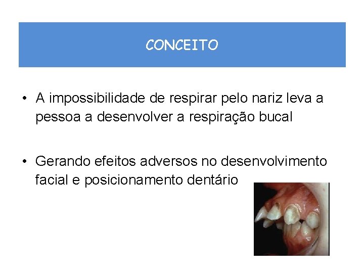 CONCEITO • A impossibilidade de respirar pelo nariz leva a pessoa a desenvolver a