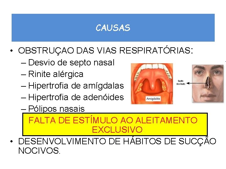 CAUSAS • OBSTRUÇAO DAS VIAS RESPIRATÓRIAS: – Desvio de septo nasal – Rinite alérgica
