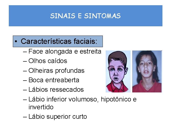 SINAIS E SINTOMAS • Características faciais: – Face alongada e estreita – Olhos caídos