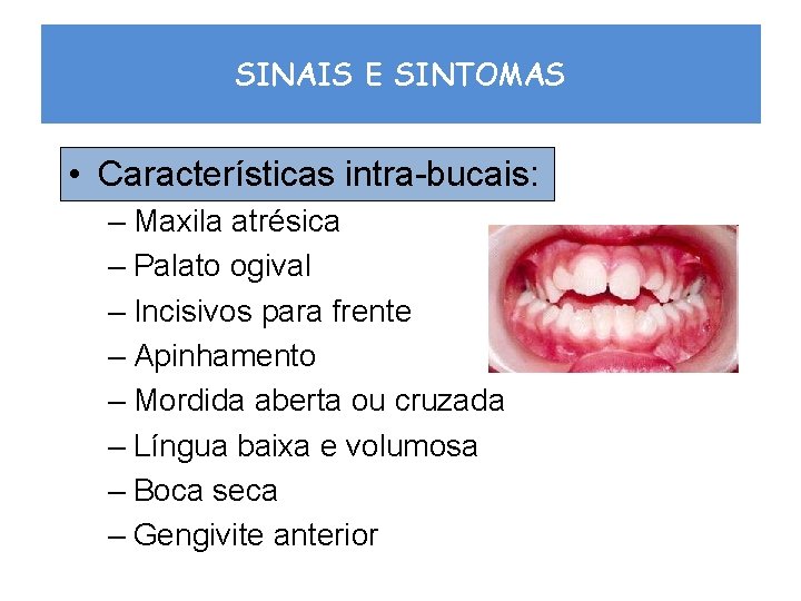 SINAIS E SINTOMAS • Características intra-bucais: – Maxila atrésica – Palato ogival – Incisivos
