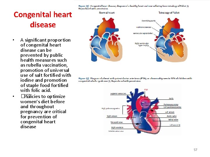 Congenital heart disease • • A significant proportion of congenital heart disease can be