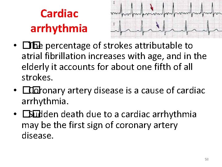 Cardiac arrhythmia • �� The percentage of strokes attributable to atrial fibrillation increases with