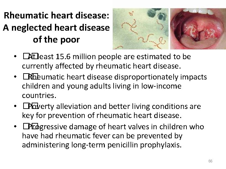 Rheumatic heart disease: A neglected heart disease of the poor • �� At least