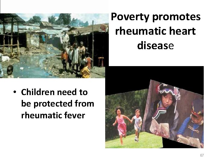 Poverty promotes rheumatic heart disease • Children need to be protected from rheumatic fever