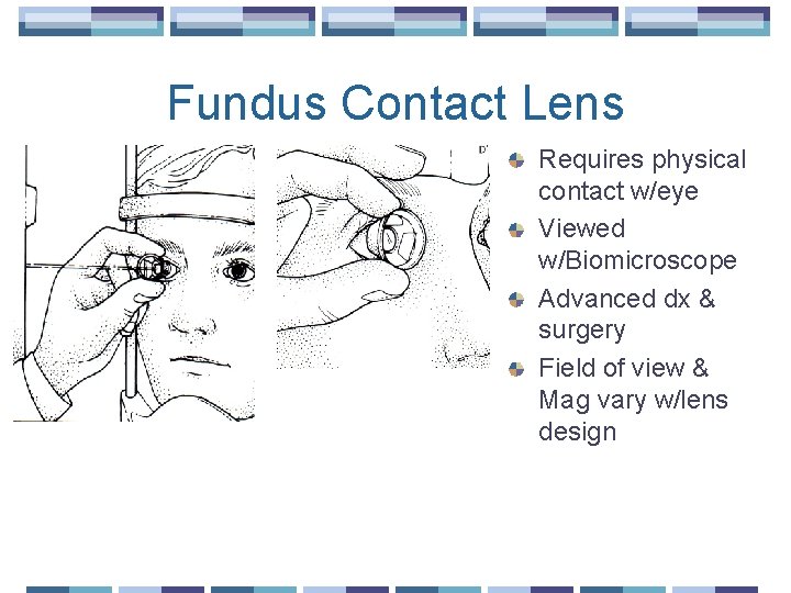 Fundus Contact Lens Requires physical contact w/eye Viewed w/Biomicroscope Advanced dx & surgery Field