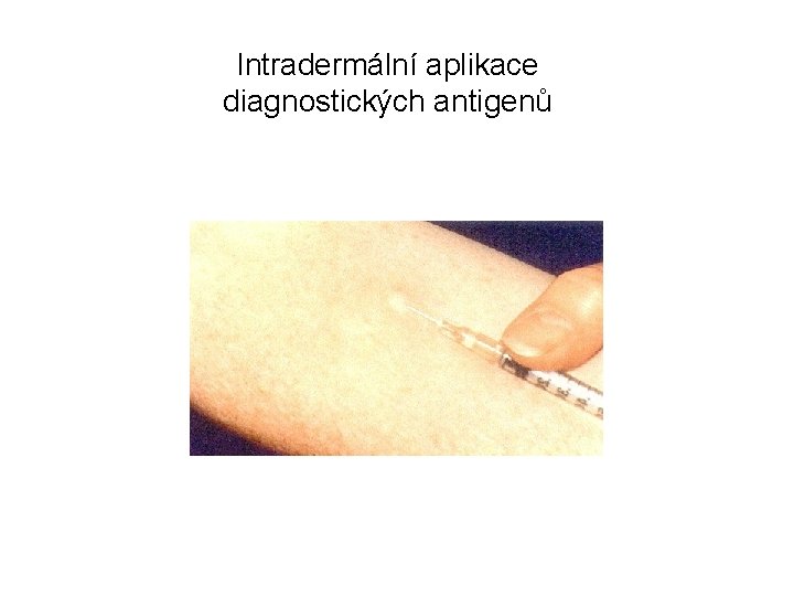 Intradermální aplikace diagnostických antigenů 