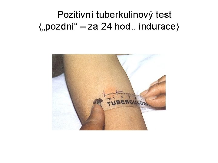 Pozitivní tuberkulinový test („pozdní“ – za 24 hod. , indurace) 