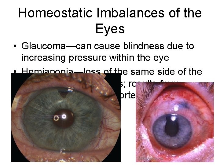 Homeostatic Imbalances of the Eyes • Glaucoma—can cause blindness due to increasing pressure within
